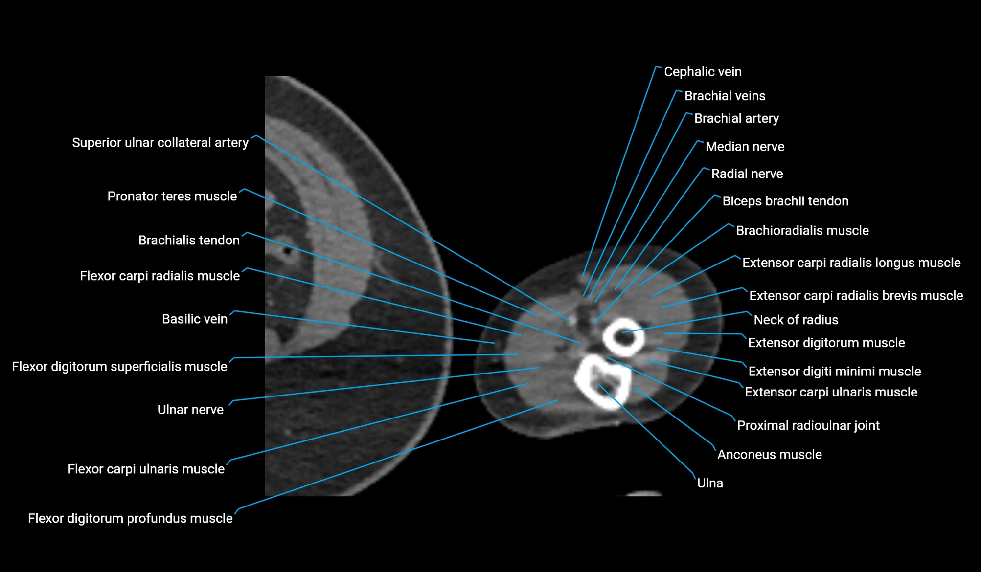 CT upper arm axial  cross sectional anatomy labelled radiology image -00414.webp